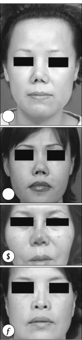 Fig. 26. 양측에 costal cartilage를 이용하여 늘리는 실제 수술예  (A).  비중격연골을 이용하여 일측에 extended  sp-reader graft를 대는 수술 중 사진  (B)