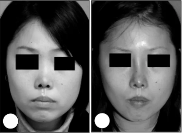 Fig. 33. 늑연골  (costal cartilage)을 이용한 융비술 후에 발 생한 warping. AAAA  A AA A  BBB B  Fig. 34