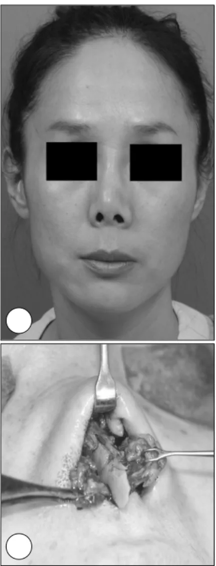 Fig. 6. Supratip  부위가 약간 꺼진 것을 불평하는 경우 교 정을 위한 수술 중 사진으로 우선 꺼진 부위만큼 e-PTFE를  조각한다  (A), Jung’s forceps로  잡은 후에 #26 gauze  nee-dle로 percutaneous 고정한다 (B, C)