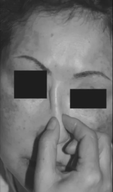 Fig. 12. 비내 접근법  (endonasla approach)시 선단절개 (rim incision)  후 발생한 봉합부위 반흔. 