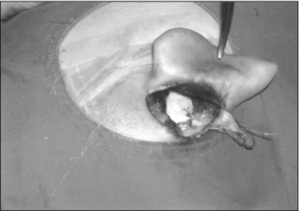 Fig. 3. The feature shows the finding after the cochlear implant is positioned. 