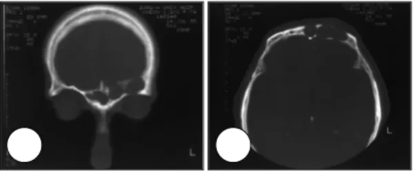 Fig. 1. Preoperative coronal PNS CT scans of postope- postope-rative cheek cyst. A：It shows an unilocular cystic le-sion  in the right maxillary sinus