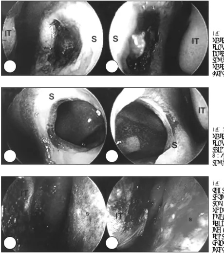 Fig. 1. The endoscopic view of both  nasal cavity 8 days after the injury,  showing about 7×7 mm sized  mu-cosal defect and necrosis in the  sep-tum