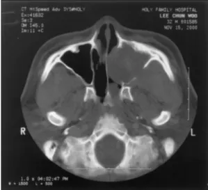 Fig. 2. Preoperative  axial (A) and coronal  (B) CT scan shows  that a large soft-tissue  mass arising from left  nasal cavity extends  into the left maxillary  sinus, right nasal  ca-vity, nasal septum,  la-teral wall of the right  nasal fossa and  infe-r