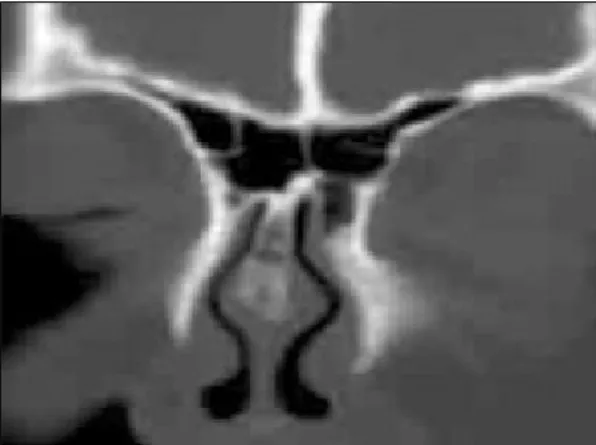 Fig. 3. Preoperative sagittal MRI scan：Linear connection  like fistula reaches cystic mass within the ethmoidal roof