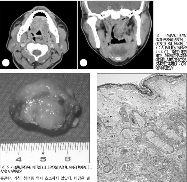Fig. 1. Enhanced na- na-sopharyngeal  com-puted tomogram.