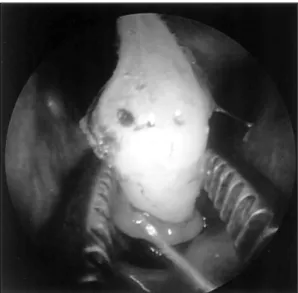 Fig. 2. Preoperative computed tomography. High density  mass (arrow) is shown in coronal OMU CT scan