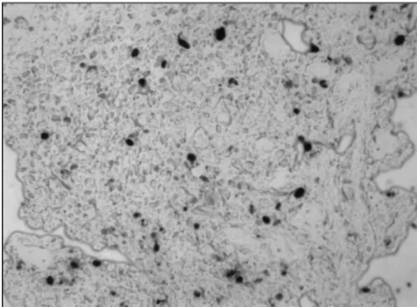Fig. 5. Some number of neoplastic lymphoid cells show  positive reaction for EBER in situ hybridization