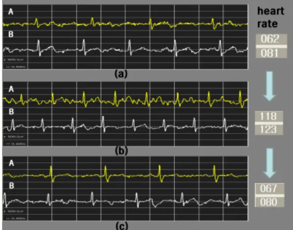 Fig. 6. Typical ECG. [6]
