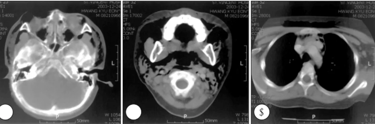 Fig. 3. Three computed tomography scans at the nasal bone level (A), the parapharyngeal and tonsil level (B), and  the carina level (C)