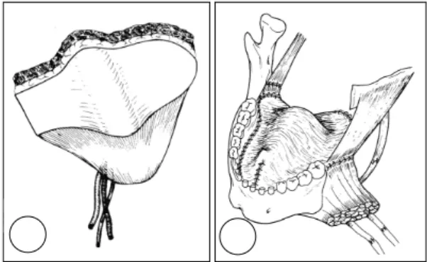 Fig. 5. Latissimus dorsi free flap. A：Flap as harvested,  with musculocutaneous component, vessels, and nerve