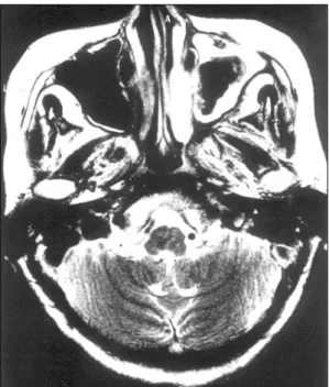 Fig. 1. Coronal CT scan showing total hazziness with hy- hy-perattenuated lesion in left maxillary sinus