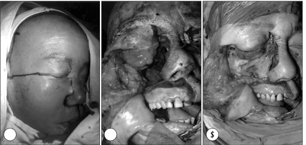 Fig. 2. A：Skin incision was designed. B：After facial flap was elevated and infraorbital nerve was transected, osteotomies were done at nasal bone, frontal process of zygomatic bone, zygomatic arch, and inferior aspect of maxilla