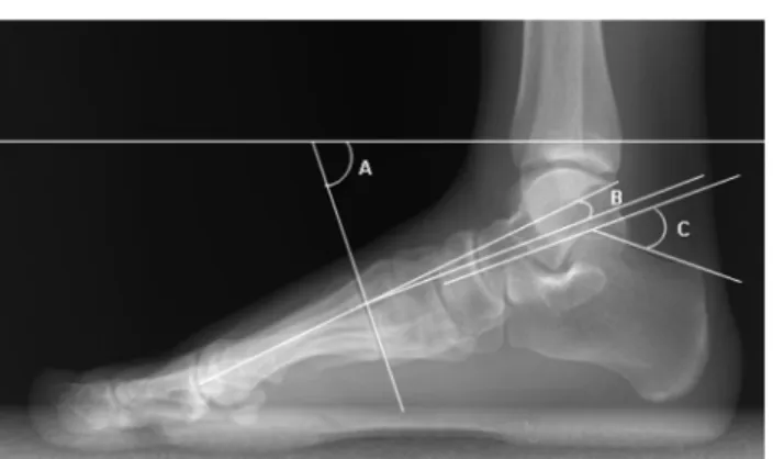Fig. 1. Illustrations of foot angles, A, Proximal first metatarsal-base (MTP); B, Talometatarsal angle (TM);  C, Böhler's angle (CP).