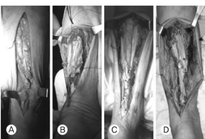 Fig.  2.  A  66-year-old  woman  with  bilateral  Achilles  tendon ruptures. (A) Intraoperative findings show Achilles tendon  rupture,  degenerative  changes  at  both  sides  of  rupture  end with large defect in the right ankle