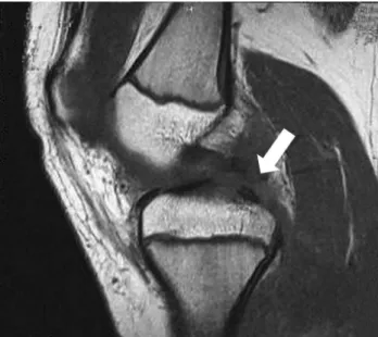 Fig. 1. MRI finding of the right knee of 12-year-old boy.