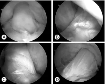 Fig. 3. The arthroscopic classification of the extent of syno- syno-vial coverage to the reconstructed ACL