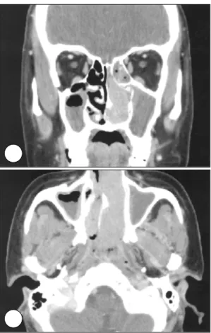 Fig. 2. Initial contrast-enhanced axial CT scan of 30-year- 30-year-old female. A and B：75×73×16 mm sized, partially  se-ptated cystic mass is seen in the right lower posterior  ce-rvical triangle