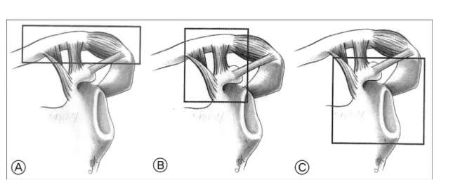 Fig. 1.The superior shoulder suspensory complex comprises three component: A; the clavicular- ac- ac-romioclavicular joint-acromial strut; B; the clavicular-coracoclavicular ligamentous-coracoid linkage;
