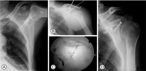 Fig.  7.  A;  The  arthroscopic  findings  show  well  reduced  joint surface of the displaced glenoid cavity