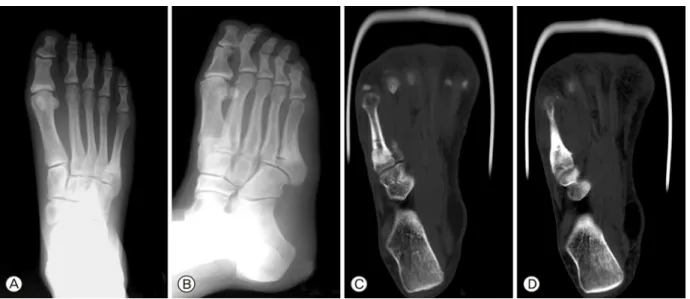 Fig. 5. Plain radiographs (A, B) and CT (C, D) were taken 1 year after 2 nd  operation