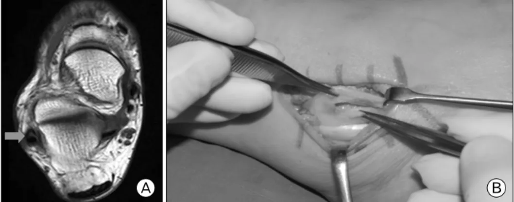 Fig. 4. (A) The T1 coronal image of  ankle  MRI  shows  Low-lying  muscle Belly (arrow) which  ex-ists  to  distal  of  the  peroneal  groove