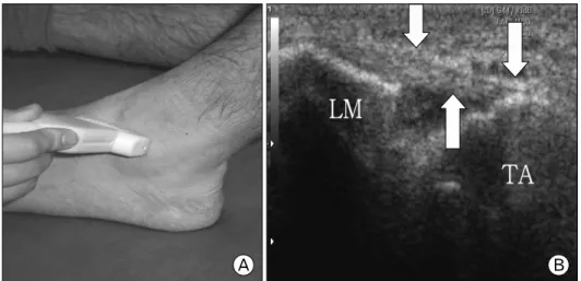 Fig.  1.  Normal  anterior  talo- talo-fibular ligament Long-axis 3-10 MHz  (megahertz)  (US)  image