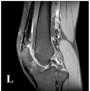 Fig. 6. Sagittal  views  of  T2  weighted  MRI  postoperatively 1  yr  later  shows  the  good  continuity  of  repaired   quad-riceps  tendon