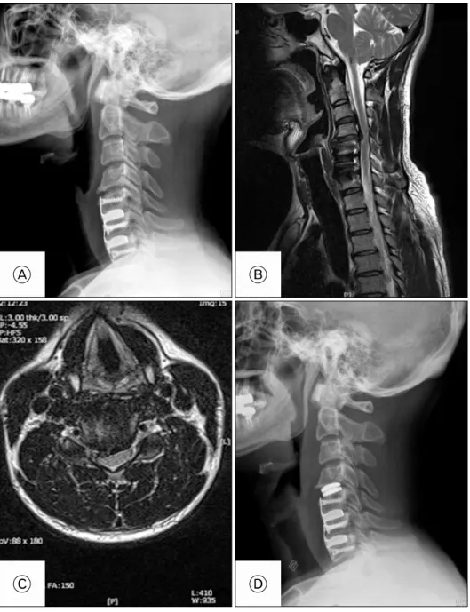Fig. 1. Plain C-spine lateral ra- ra-diogram (A) showing an anterior fusion  and  fixation  on  C5-6-7  and  osteophyte  formation  on  C4-5  disc  space