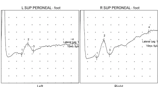 Fig.  1.  Electrodiagnostic  study  shows  markedly  decreased  left  side SNAP amplitude compared with right