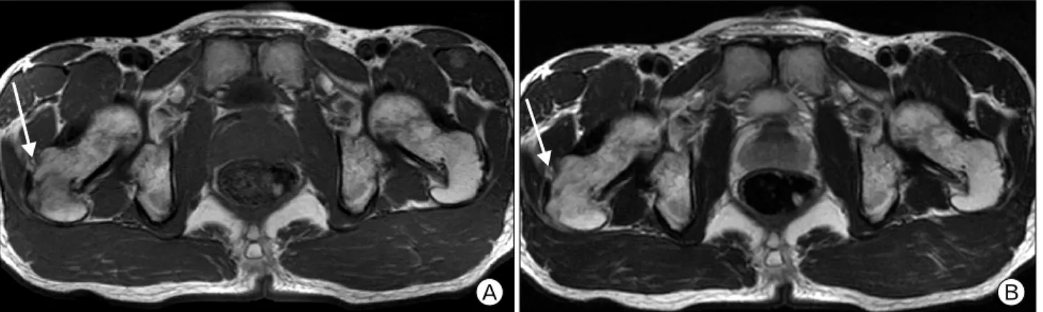 Fig. 2. (A) T1-weighted axial image shows the low singnal (arrow) around the insertion site of right gluteus medius muscle.
