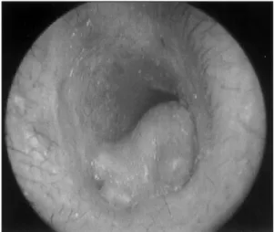 Fig. 3. Microphotograph of osteoma is showing trabecu- trabecu-lae of lamellar bone and loose fibrous tissue with blood  vessels (H-E,×40)