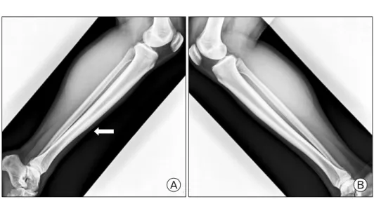 Fig.  3.  The  plane  radiography  show  improved  cortical  break  line (arrow) of anterior cortex of  right  (A)  tibia  and  bone   con-solidation  of  left  (B)  tibia.
