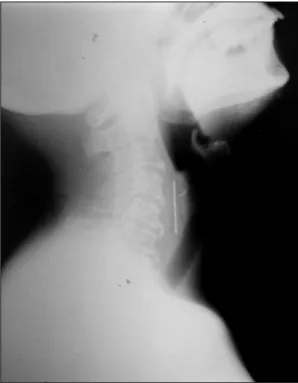 Fig. 1. Lateral view neck shows metallic foreign body. 