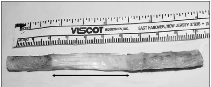 Fig. 1. The patellar tendon length was measured with ruler intraoperatively.서    론전방십자인대 손상은 스포츠 인구 증가에 따라 증가하는 추세이며 보존적 치료 후에도 불안정성이 잔존하는 경우 시행되는 전방십자인대 재건술은 문헌에서 좋은 결과를 보고하고 있다1,2)