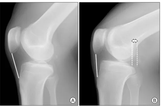 Fig. 2. The patellar tendon length was measured on both true  lat-eral  (A)  and  oblique  latlat-eral  (B)  radiograph