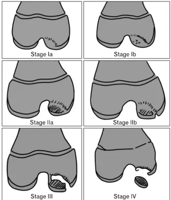 Fig. 1. This illustration shows Bedouelle’s radiologic clas- clas-sification  (Data  from  Hayan  et  al