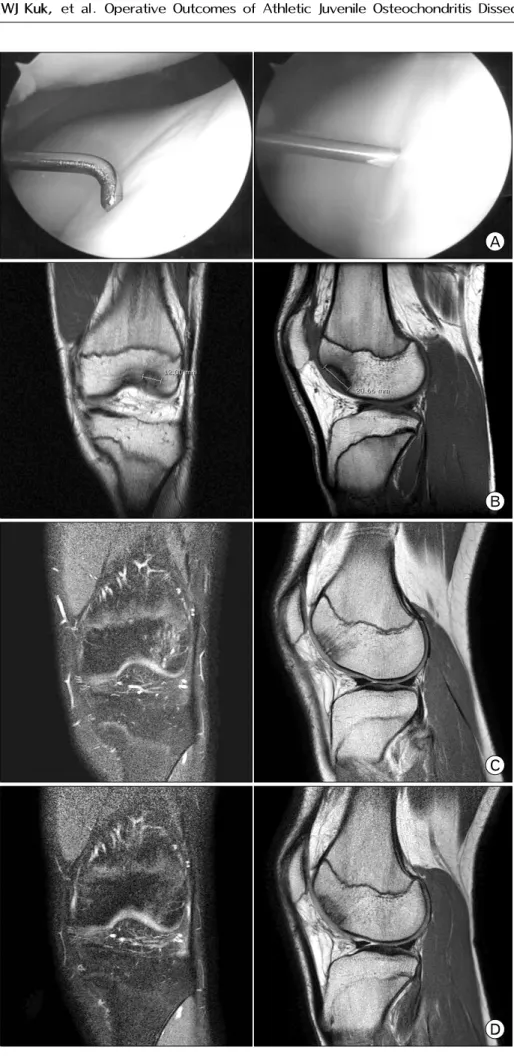 Fig. 2. A 16-year-old male patient with  osteochondritis  dissecans  in  the  left  trochlear  lesion