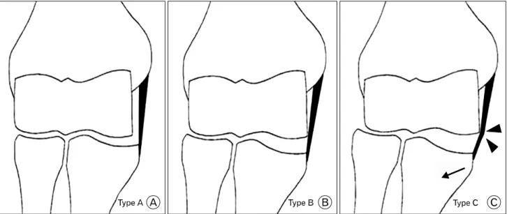 Fig. 1. Three types of angular changes of the medial collateral ligament. (A) Type A: normal stable elbow joint