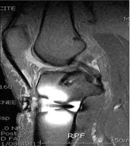 Fig. 1. Metallic artifact on tibial side in group A patient that using  metallic  screw.