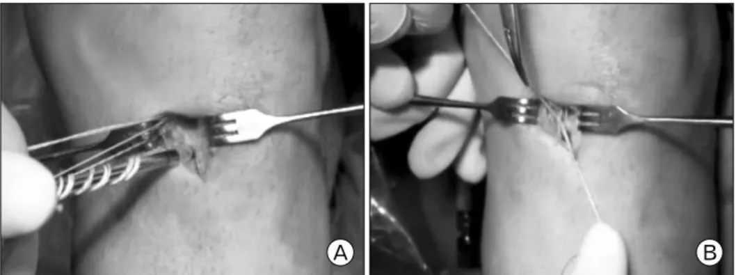 Fig.  2.  (A)  Bioabsorbable  suture  anchor  (Duet  Suture  Anchor,  Linvatec  Corp.,  Largo,  FL,  USA)