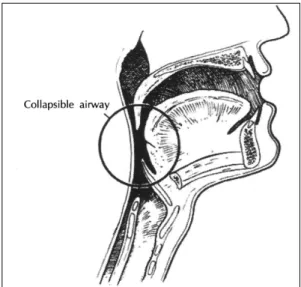 Fig. 2. Intra-oral view demonstrates some common an- an-atomical features of snorers. 