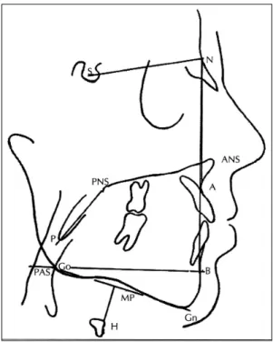 Fig. 5. Polysomnographic tracing demonstrating obst- obst-ructive apnea (A), mixed apnea (B), central apnea (C), and hypopnea (D)