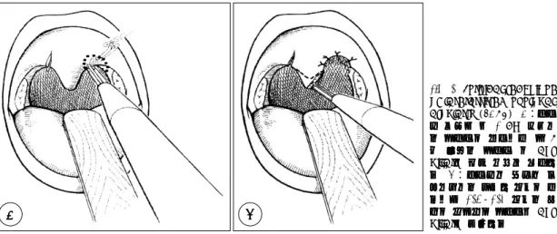 Fig. 1. Surgical technique  of laserassisted  uvulopal-atoplasty  (LAUP). A：구개구개구개구개 수 수수수   외측에외측에외측에외측에   약약약 약   1 cm  상방으상방으상방으상방으 로로로 로  연구개를연구개를연구개를 연구개를  절개하고절개하고 절개하고,  역절개하고역역 역  U 자 자자자   형태로형태로형태로 형태로   연구개연구개연구개연구개   및및및 및   ant