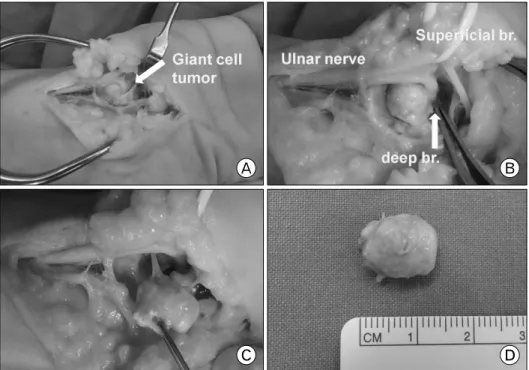 Fig. 1. Intraoperative view of the ulnar  tunnel.  (A)  The  mass  was  identified in Guyon’s canal,  im-mediately beneath the ulnar nerve.