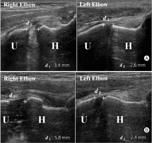 Fig.  3.  Bilateral  gravity  valgus  stress  sonographic  images  in  (A) partial and (B) complete  ul-nar collateral ligament tear  play-ers show increased ulnohumeral distance  ( d 1 – d 2 )  of  0.8  mm  and  2.4  mm  than  uninjured  left   el-bows,  