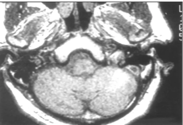 Fig. 2. T1 weighted axial image shows relatively round  increased high signal intensity lesion in the left anterior  inferior cerebellar artery (AICA) region