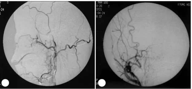 Fig. 4. Gd-enhanced T1-weighted MRI scan shows high signal intensity of portion in the right maxillary sinus (A) and differently enhancing portion in the nasopharynx (arrow)(B)