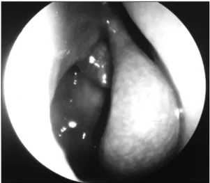 Fig. 1. Preoperative endoscopic view of the right nasal cavity. An irregular surficed mass is visible in the right middle meatus