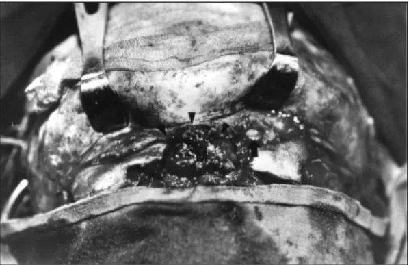 Fig. 4. Postoperative coronal CT image. The superior orbital rim (arrow) was reconstructed with inner table of frontal cranium